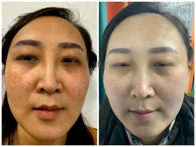 前后效果图
