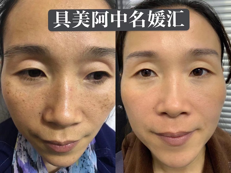 雀斑