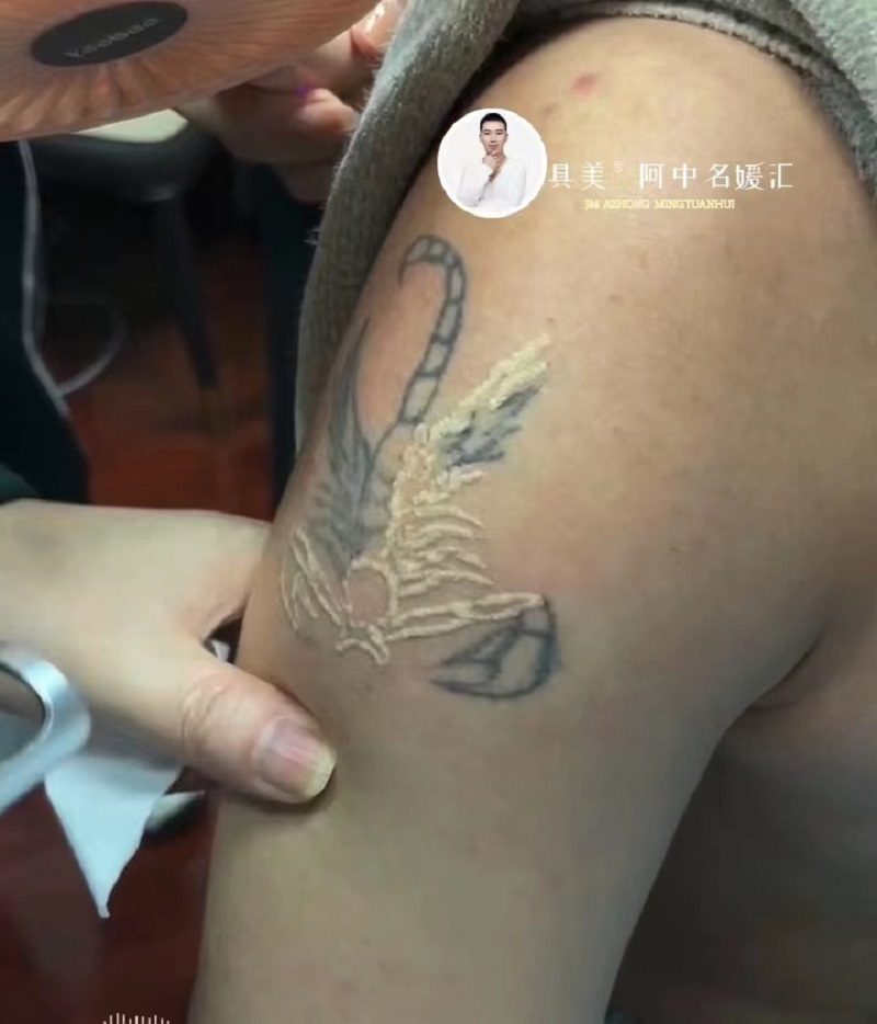 洗纹身